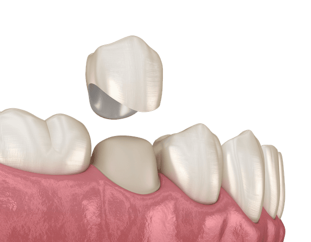 dental-crown-image